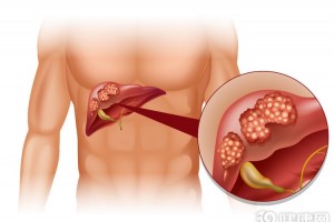 为什么体检肝功能正常成果却查出肝癌这次给你解说清楚