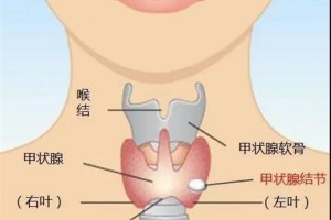 有了甲状腺结节要紧吗