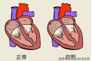 房颤知道有四大误区你知道吗